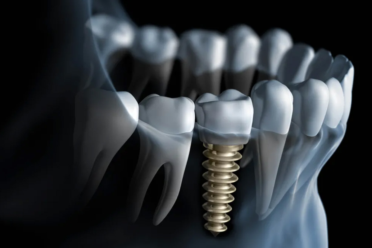 Dental implants Etobicoke