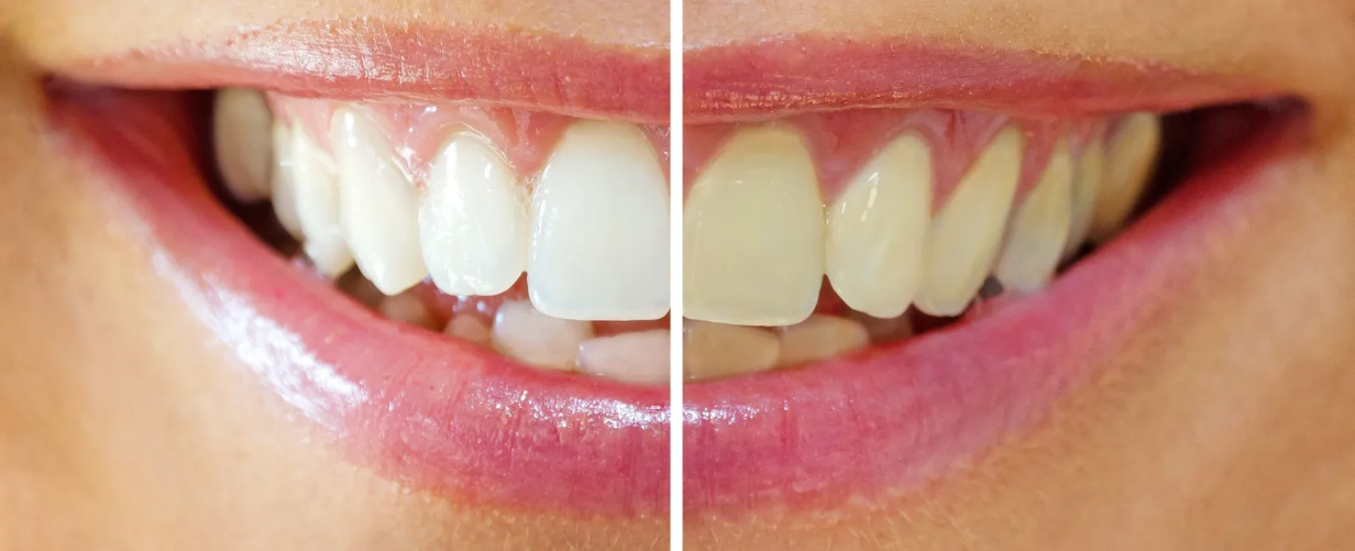 Teeth whitening in Etobicoke